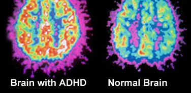 The Truth About Living with ADHD